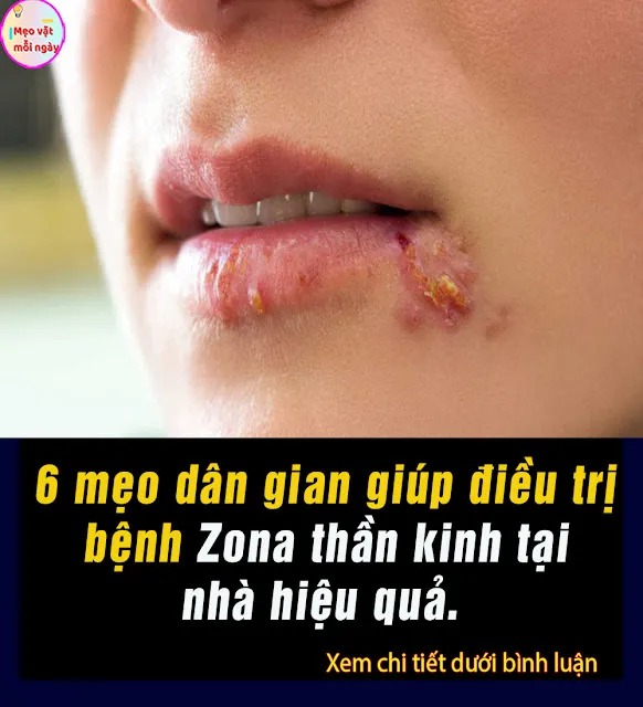 6 mẹo Dân Gian giúp điều trị b;ệnh Zo;na th;ần k;inh tại nhà hiệu quả..